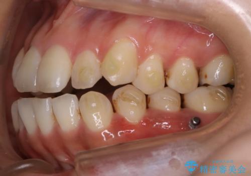 【非抜歯】20代女性 歯のガタつきと噛み合わせの治療の治療中