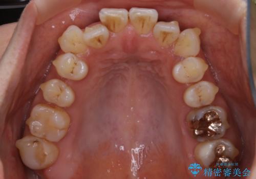 【非抜歯】20代女性 歯のガタつきと噛み合わせの治療の治療中
