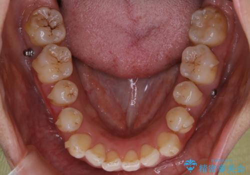 【非抜歯】20代女性　歯のガタつきと噛み合わせの治療の治療中