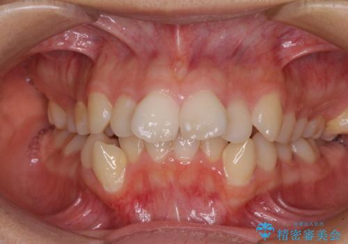 八重歯と乱れた咬み合わせを改善　ワイヤー装置での抜歯矯正の症例 治療前