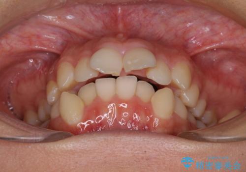 八重歯と乱れた咬み合わせを改善 ワイヤー装置での抜歯矯正の治療前