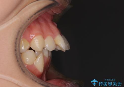 八重歯と乱れた咬み合わせを改善 ワイヤー装置での抜歯矯正の治療前