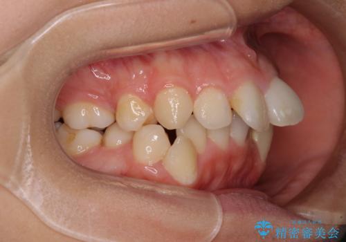 八重歯と乱れた咬み合わせを改善 ワイヤー装置での抜歯矯正の治療前
