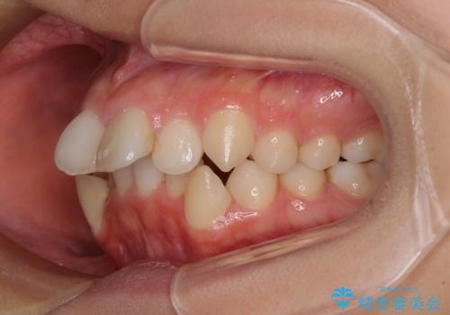 八重歯と乱れた咬み合わせを改善　ワイヤー装置での抜歯矯正の治療前