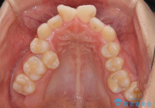 八重歯と乱れた咬み合わせを改善 ワイヤー装置での抜歯矯正の治療前