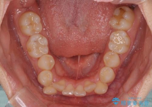 八重歯と乱れた咬み合わせを改善 ワイヤー装置での抜歯矯正の治療前