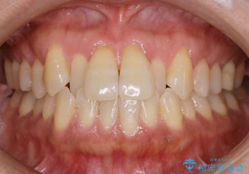【非抜歯】短期間で実現する前歯の反対咬合治療の症例 治療前