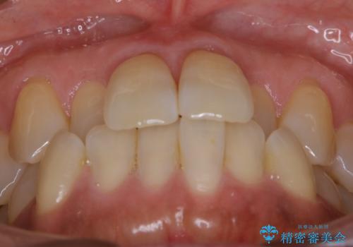 【非抜歯】短期間で実現する前歯の反対咬合治療の治療前