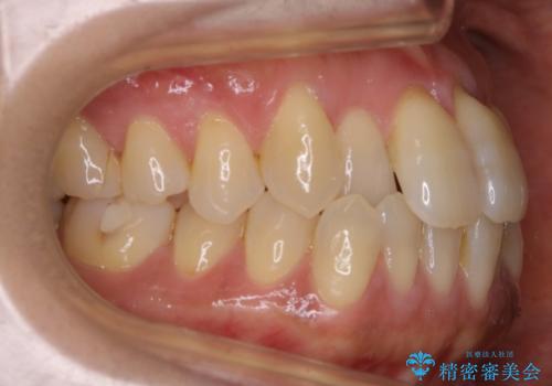 【非抜歯】短期間で実現する前歯の反対咬合治療の治療前