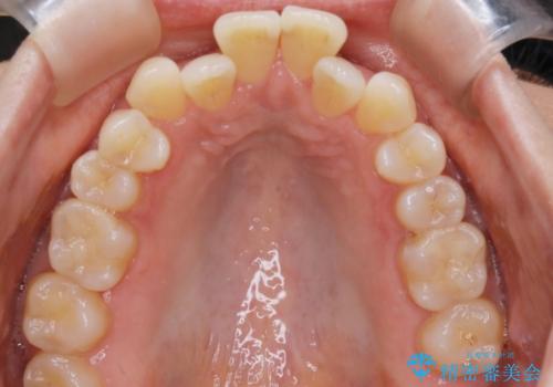 【非抜歯】短期間で実現する前歯の反対咬合治療の治療前
