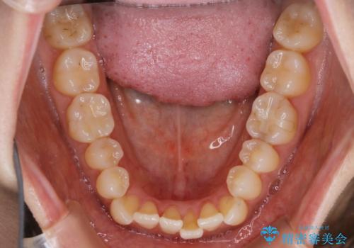 【非抜歯】短期間で実現する前歯の反対咬合治療の治療前
