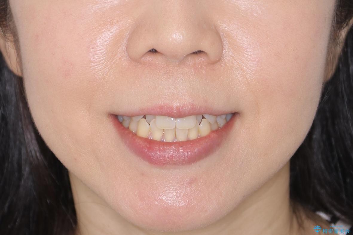 【非抜歯】短期間で実現する前歯の反対咬合治療の治療前（顔貌）