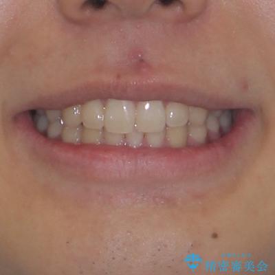 欠損した前歯とディープバイト　ワイヤー矯正で短期間で治療の治療後（顔貌）