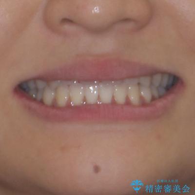 前歯のクロスバイトを治したい ワイヤー装置による矯正治療の治療後(顔貌)