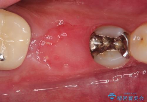 【インプラント】食事中に歯が割れた! かなり深いところまで歯が割れていたの治療中