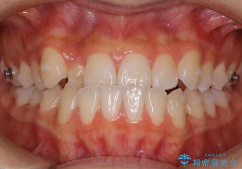 【非抜歯】受け口の改善　10代で始める本格的噛み合わせ治療の治療中