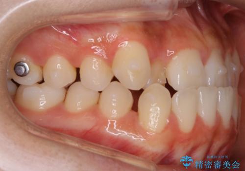 【非抜歯】受け口の改善　10代で始める本格的噛み合わせ治療の治療中