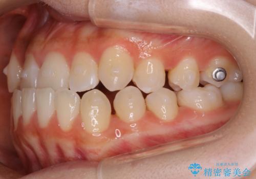 【非抜歯】受け口の改善 10代で始める本格的噛み合わせ治療の治療中