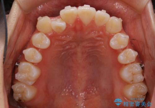 【非抜歯】受け口の改善 10代で始める本格的噛み合わせ治療の治療中