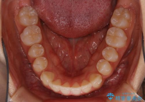 【非抜歯】受け口の改善 10代で始める本格的噛み合わせ治療の治療中
