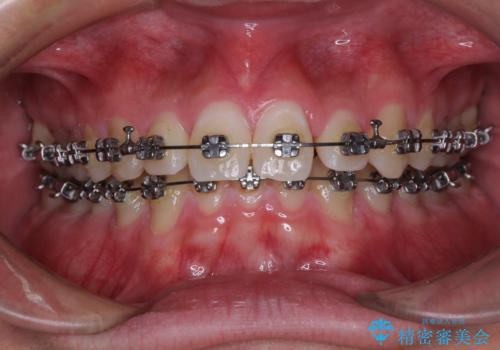 欠損した前歯とディープバイト ワイヤー矯正で短期間で治療の治療中
