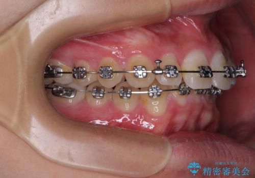 欠損した前歯とディープバイト ワイヤー矯正で短期間で治療の治療中