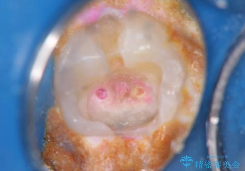 奥歯がしみる 神経を温存する治療の治療中