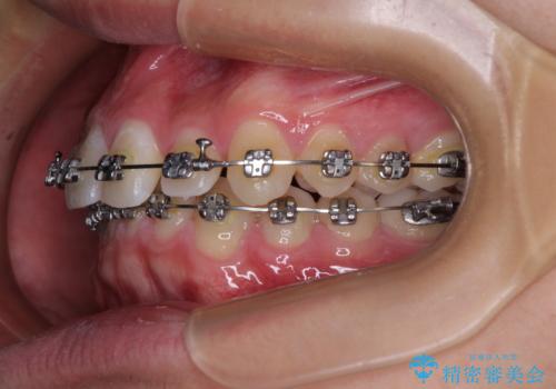 欠損した前歯とディープバイト ワイヤー矯正で短期間で治療の治療中