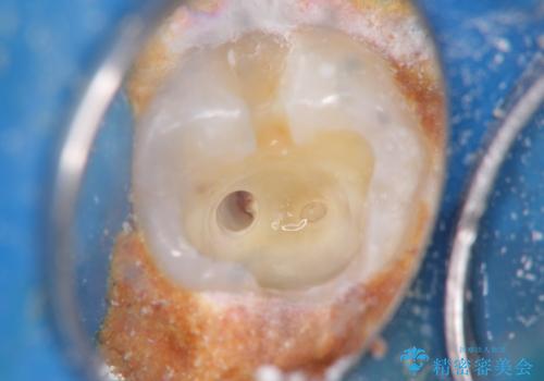 奥歯がしみる 神経を温存する治療の治療中