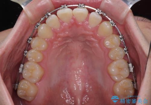 欠損した前歯とディープバイト　ワイヤー矯正で短期間で治療の治療中
