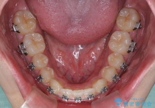 欠損した前歯とディープバイト ワイヤー矯正で短期間で治療の治療中