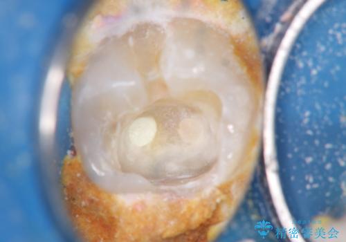 奥歯がしみる 神経を温存する治療の治療中