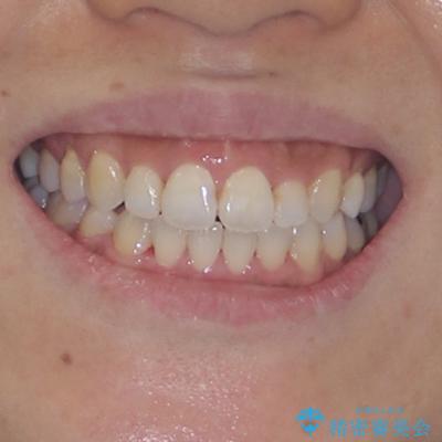 既に2本が抜歯されている歯列　咬み合わせのズレを改善する抜歯矯正の治療後（顔貌）