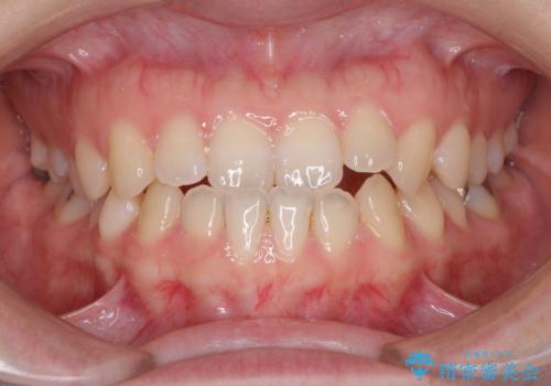 前歯のクロスバイト インビザラインによる矯正治療の症例 治療前
