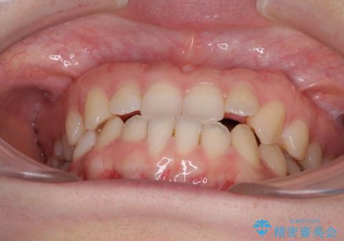 前歯のクロスバイト インビザラインによる矯正治療の治療前