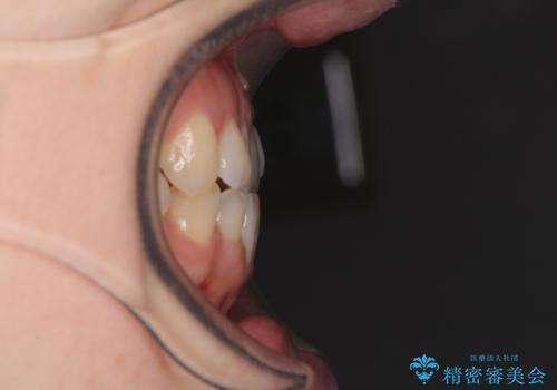 前歯のクロスバイト インビザラインによる矯正治療の治療前