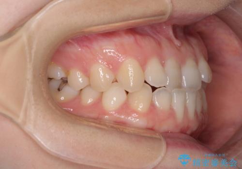 前歯のクロスバイト インビザラインによる矯正治療の治療前