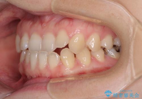 前歯のクロスバイト インビザラインによる矯正治療の治療前