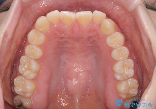 前歯のクロスバイト インビザラインによる矯正治療の治療前