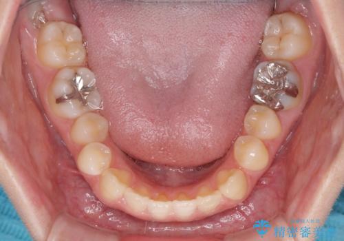 前歯のクロスバイト インビザラインによる矯正治療の治療前