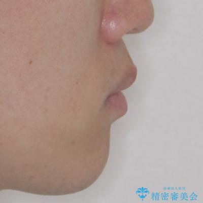 出っ歯と八重歯 目立たない裏側装置でスッキリとした口元にの治療後(顔貌)
