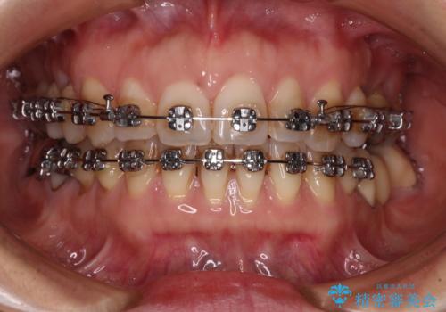 正中のズレと飛び出した前歯を改善 メタルブラケットでの抜歯矯正の治療中