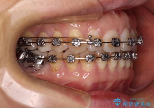 正中のズレと飛び出した前歯を改善 メタルブラケットでの抜歯矯正の治療中