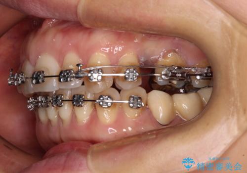 正中のズレと飛び出した前歯を改善 メタルブラケットでの抜歯矯正の治療中