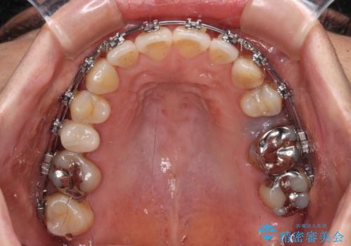 正中のズレと飛び出した前歯を改善 メタルブラケットでの抜歯矯正の治療中