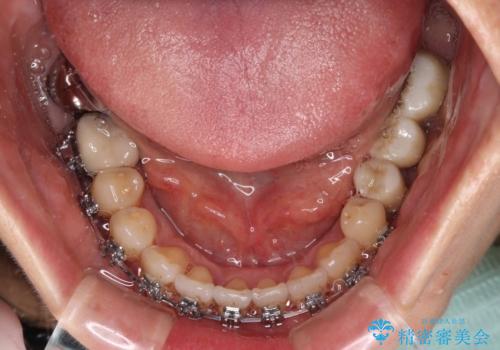 正中のズレと飛び出した前歯を改善 メタルブラケットでの抜歯矯正の治療中