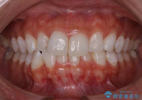 【非抜歯】歯軸を治して正しい噛み合わせへの症例 治療前