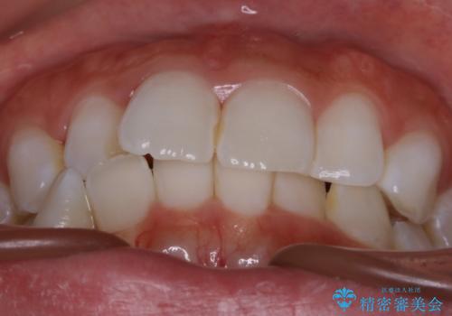 【非抜歯】歯軸を治して正しい噛み合わせへの治療前
