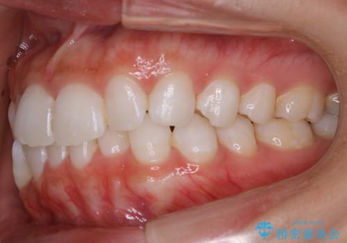 【非抜歯】歯軸を治して正しい噛み合わせへの治療前