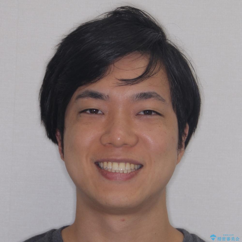 【モニター】楽して治したい メタルブラケットによる矯正治療の治療後(顔貌)